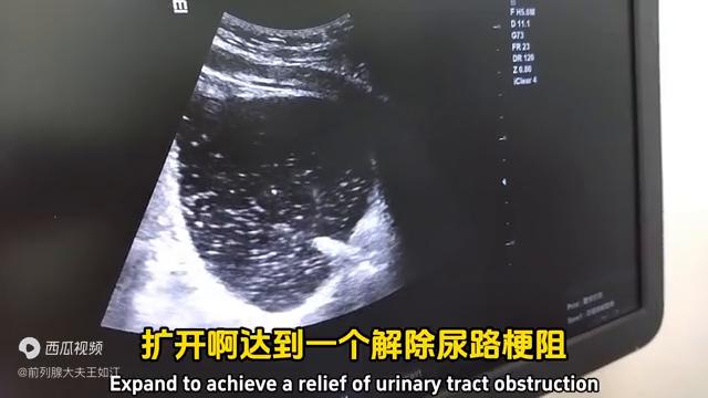 孔医生治疗前列腺炎,经尿道前列腺消融治疗步骤