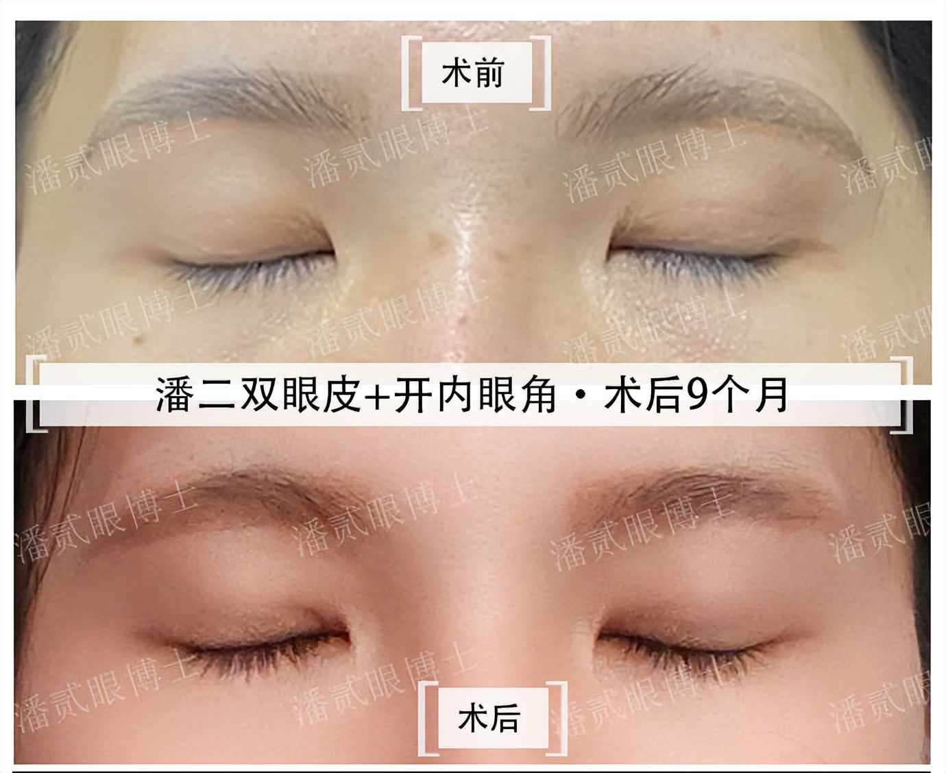 内眦赘皮用手术吗,内眼角内眦赘皮矫正不做手术