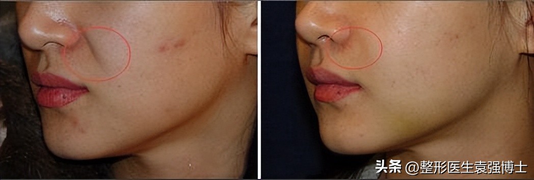 不做拉皮如何改善法令纹,法令纹严重拉皮可以改善吗