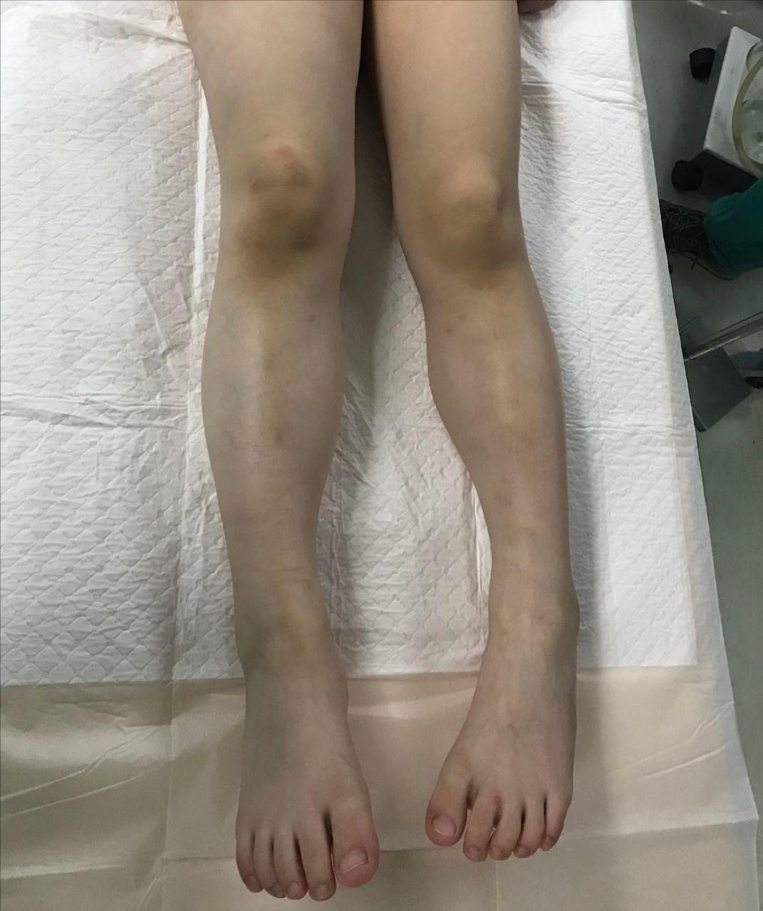 下肢静脉血管瘤,动静脉血管畸形微创介入