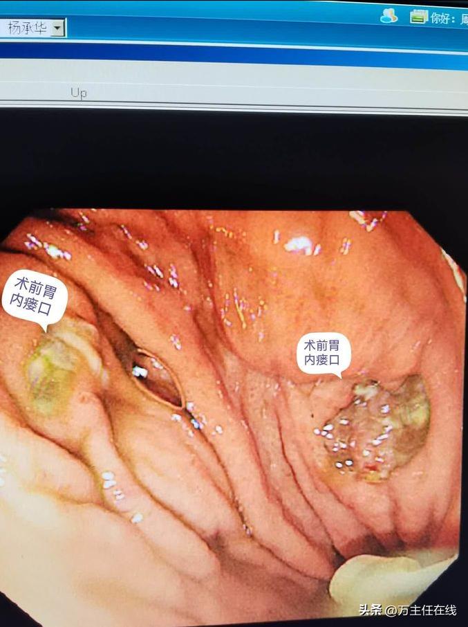 腹腔粘液癌治疗有妙招——万荣教授以内镜Notes技术成功胃减压