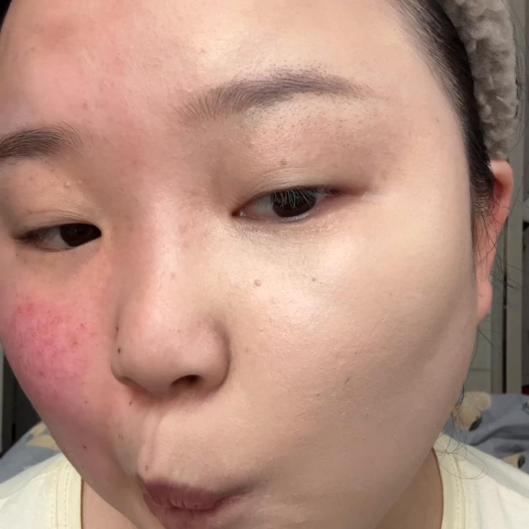 儿童妆嘴边红血丝怎么化,婴儿脸有红血丝能涂面霜吗