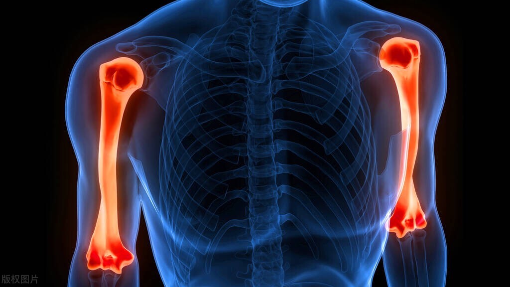 跟骨骨折和肱骨骨折哪个严重,儿童肱骨髁上骨折最常见并发症