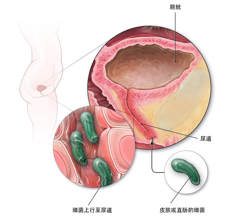 怎样避免反复的尿路感染,经常会尿路感染应该注意什么