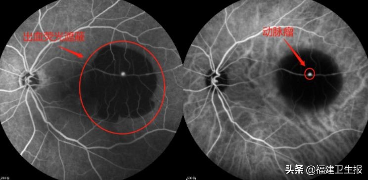 爱尔眼科专注摘镜手术,福州爱尔眼科医院技术