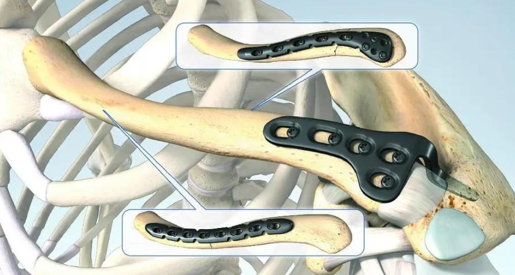 肩锁关节脱位手术多久能干体力活,左肩锁关节脱位拆钢板后多久恢复