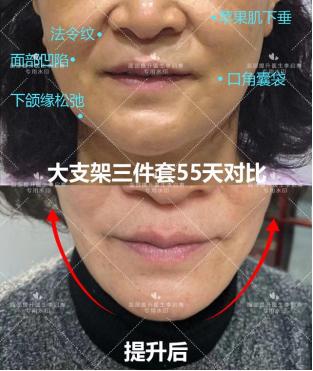 面部松弛下垂凹陷填充,鼻基底皮肤松弛怎么改善