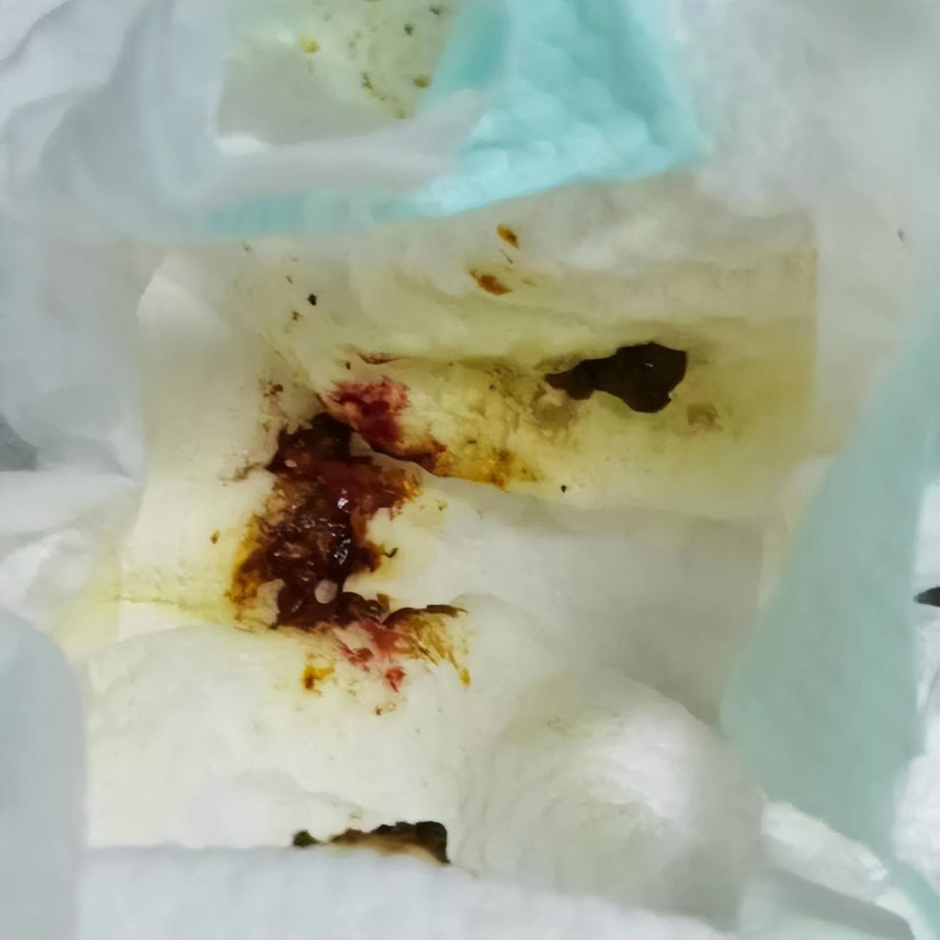 母乳宝宝便血是什么原因,纯母乳宝宝便血是怎么回事