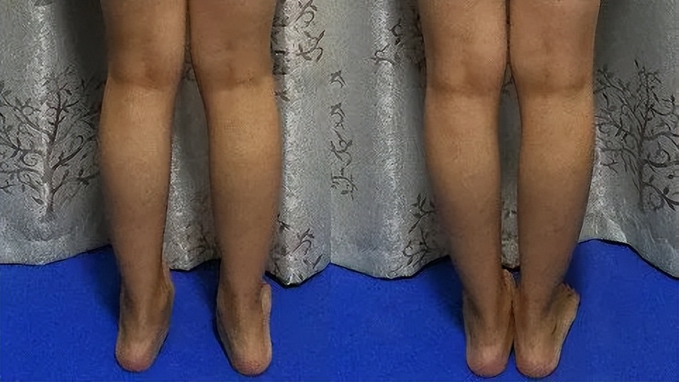 膝外翻畸形的症状,膝外翻怎么治疗