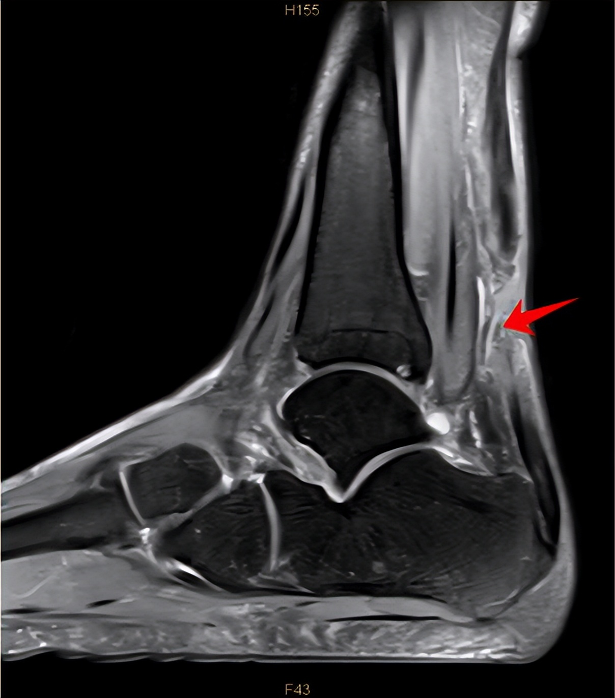 运动员跟腱断裂能恢复到100%吗,足球运动员跟腱断裂影响大吗