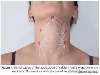 抽脂针瘦脸,抽脂溶脂针