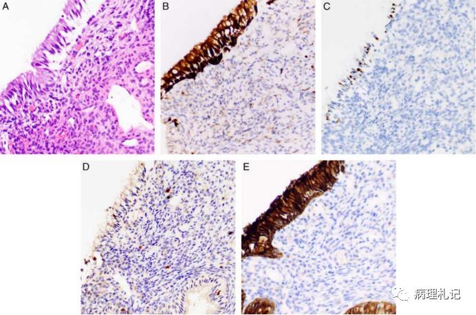 宫颈病理免疫组化p16是什么意思,p16阳性低度上皮病变严重吗