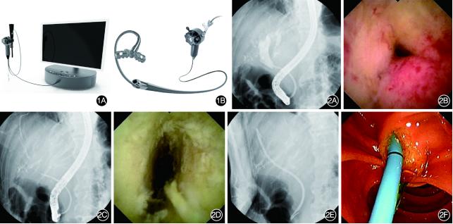 新型国产经口胆胰直视化子镜系统临床应用价值的初步分析（含视频）