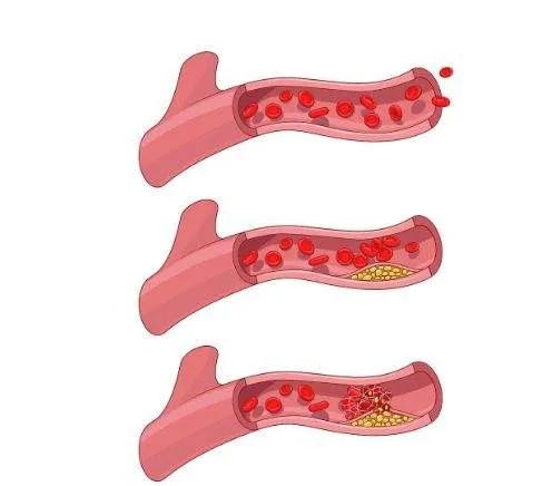 阿司匹林能溶血栓吗,溶血栓阿司匹林