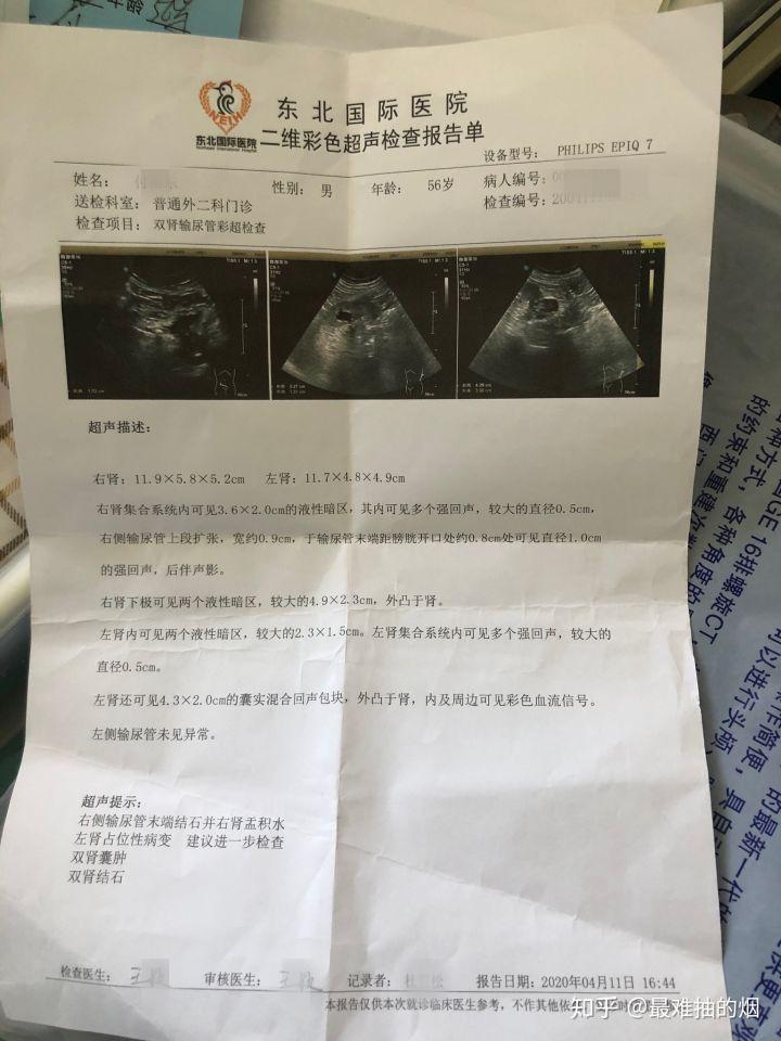 患肾癌后的心路历程,切还是不切