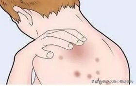 皮肤痒痒的一抓就破皮,皮肤痒痒的地方一抓就红