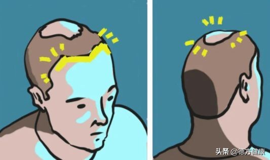 脱发真的无药可救了吗,严重脱发这几件事千万别做