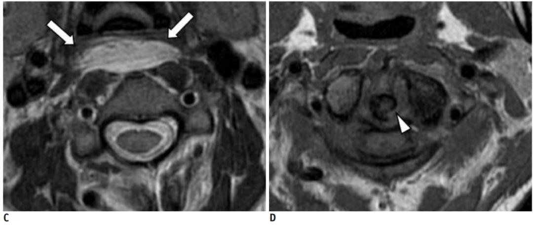 颈椎常见病变图片,颈椎严重的病例