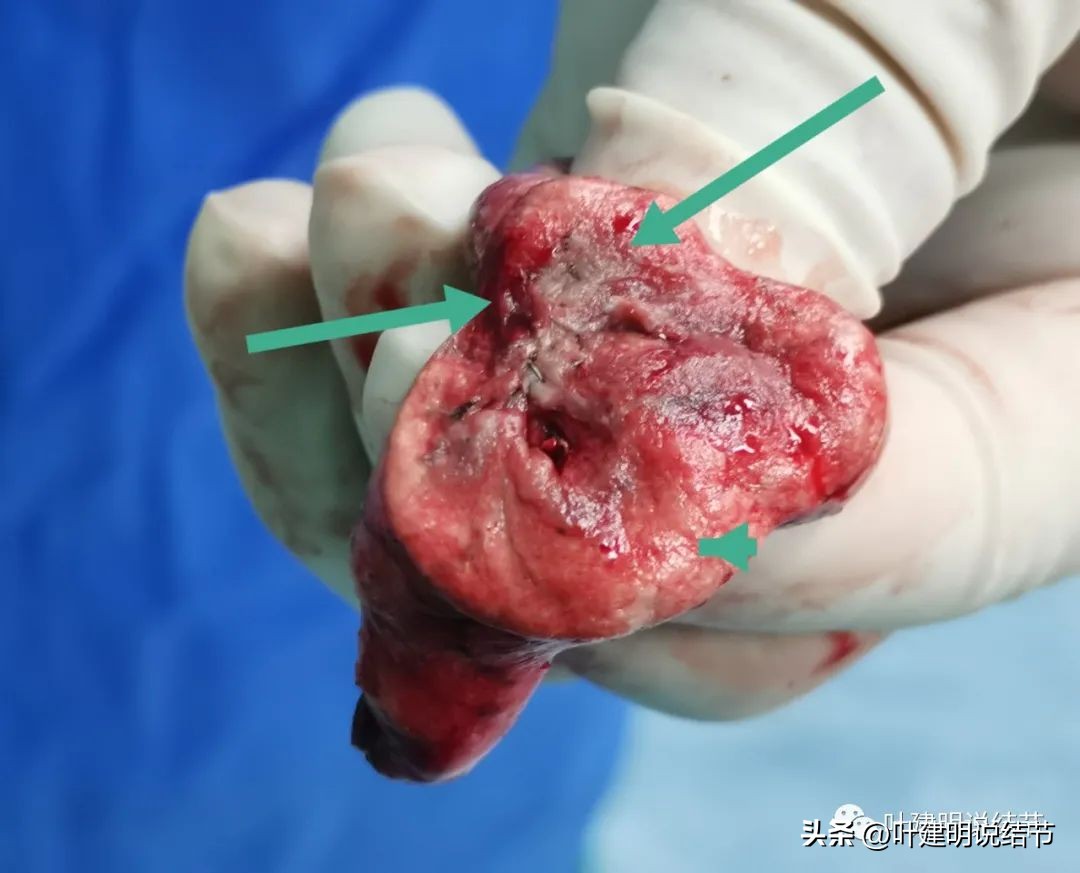 辽宁省肺结节手术哪家医院好,辽宁肺结节手术医院