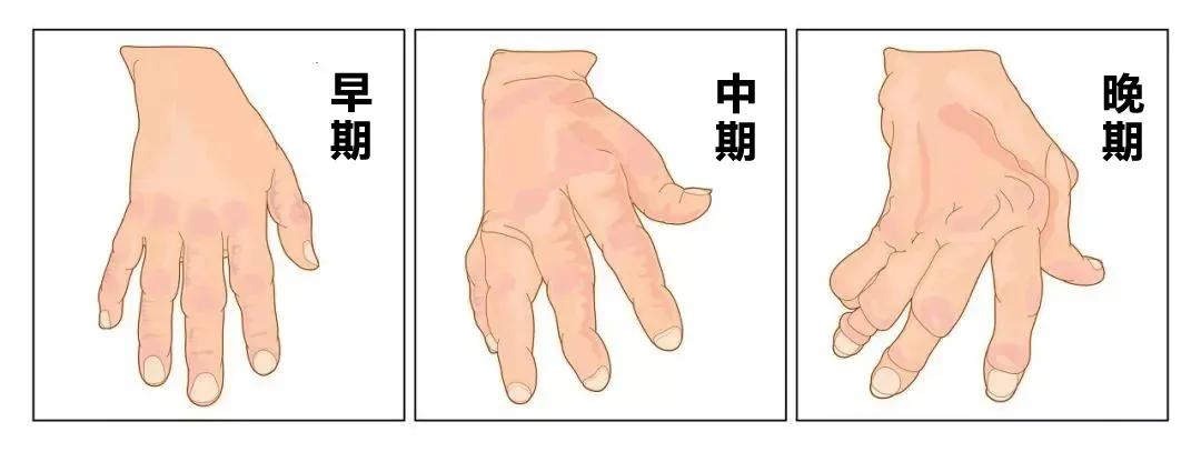 手指关节疼肿胀变形要警惕四种病,手指关节变形是风湿吗吃什么药