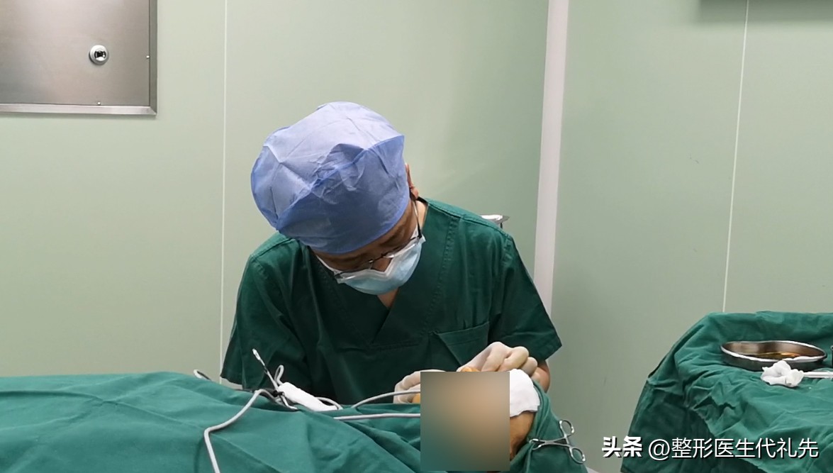 外切眼袋眼睑退缩修复手术对比,50岁外切眼袋手术真实感受