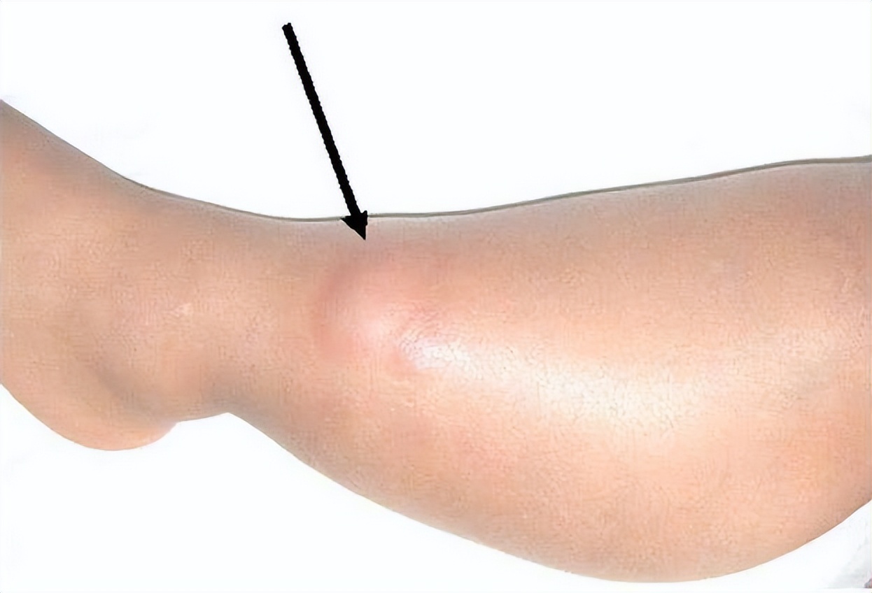 小腿肿了注意事项,小腿无缘无故酸疼是不是癌症