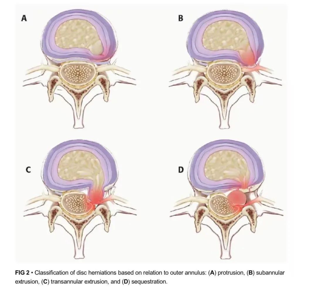 腰痛用热敷还是冷敷,腰痛该冷敷还是热敷