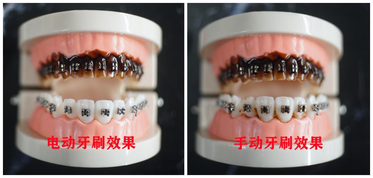 艾美格超声波牙刷是智商税吗,电动牙刷是黑科技还是智商税