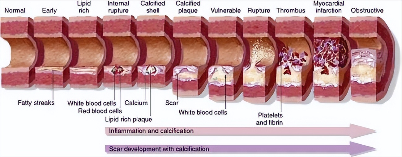 国内首个：波士顿科学血管“金刚钻”首次临床