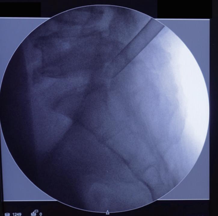 椎间孔镜微创介入治疗椎间盘突出,腰3-4椎间盘突出针刀治疗