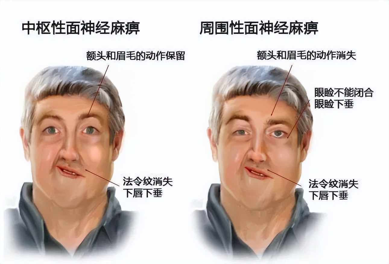 表情不受管理怎么办,表情不受控制是什么病