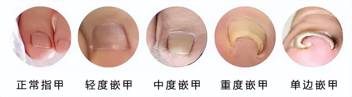 一走路脚趾甲里疼怎么回事,甲沟炎拔完脚趾甲很疼怎么办