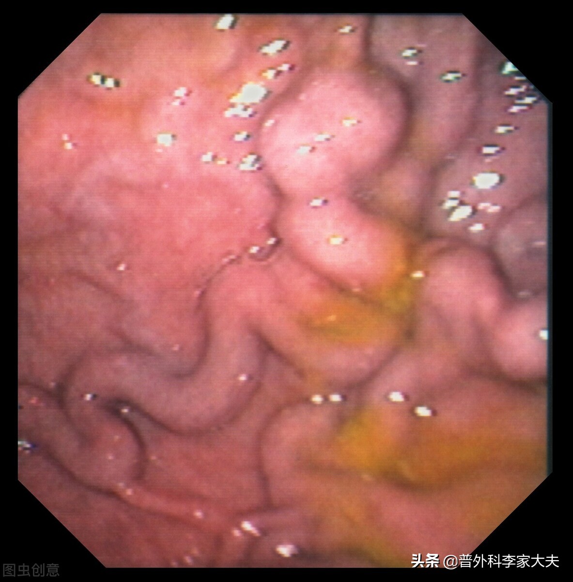 肝癌晚期拉血是鲜红的吗怎么回事,90岁肝癌晚期有得救吗