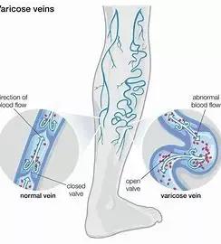 治疗下肢静脉曲张良方,怎么缓解静脉曲张下肢痛和肿