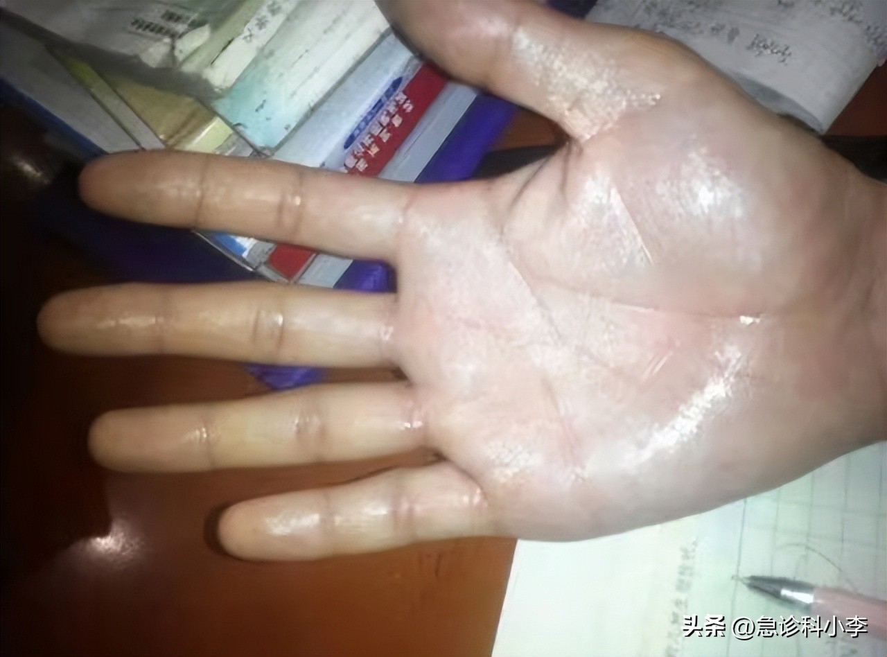 为什么有的人动不动就出汗,为什么人动不动就流汗