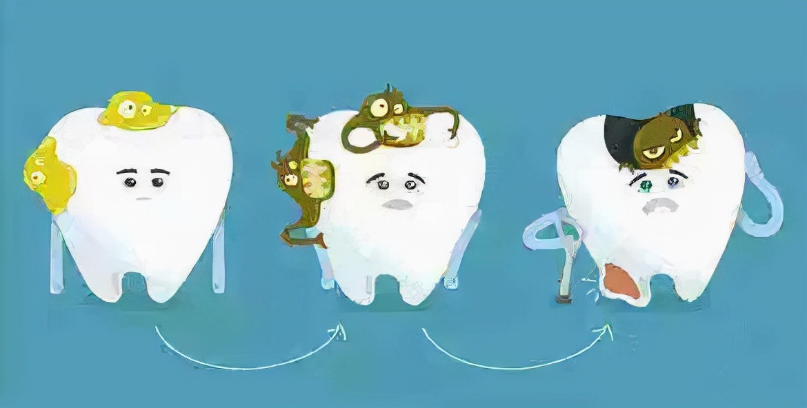 龋齿小洞不补,龋齿不及时补后果