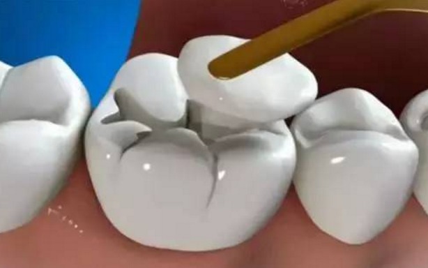 补牙材料掉了有什么影响,补牙材料过了一年掉了怎么办