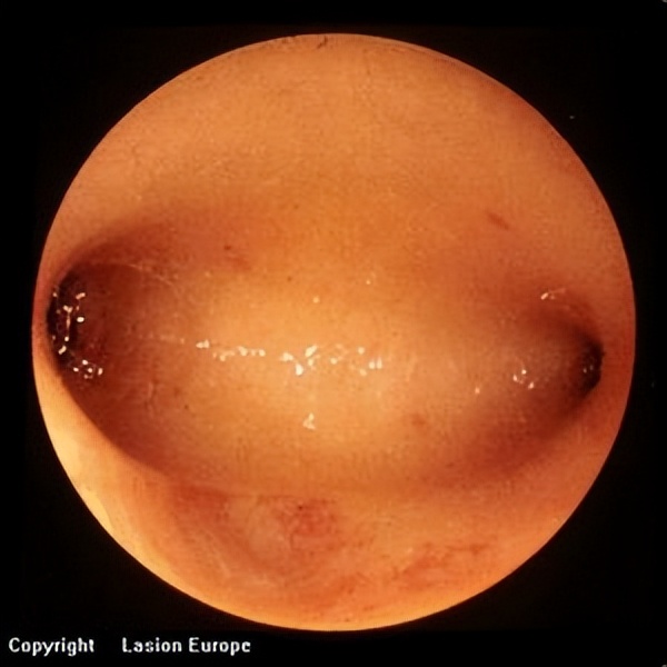 宫寒卵巢早衰月经量少怎样调理,月经量越来越少是要绝经了吗