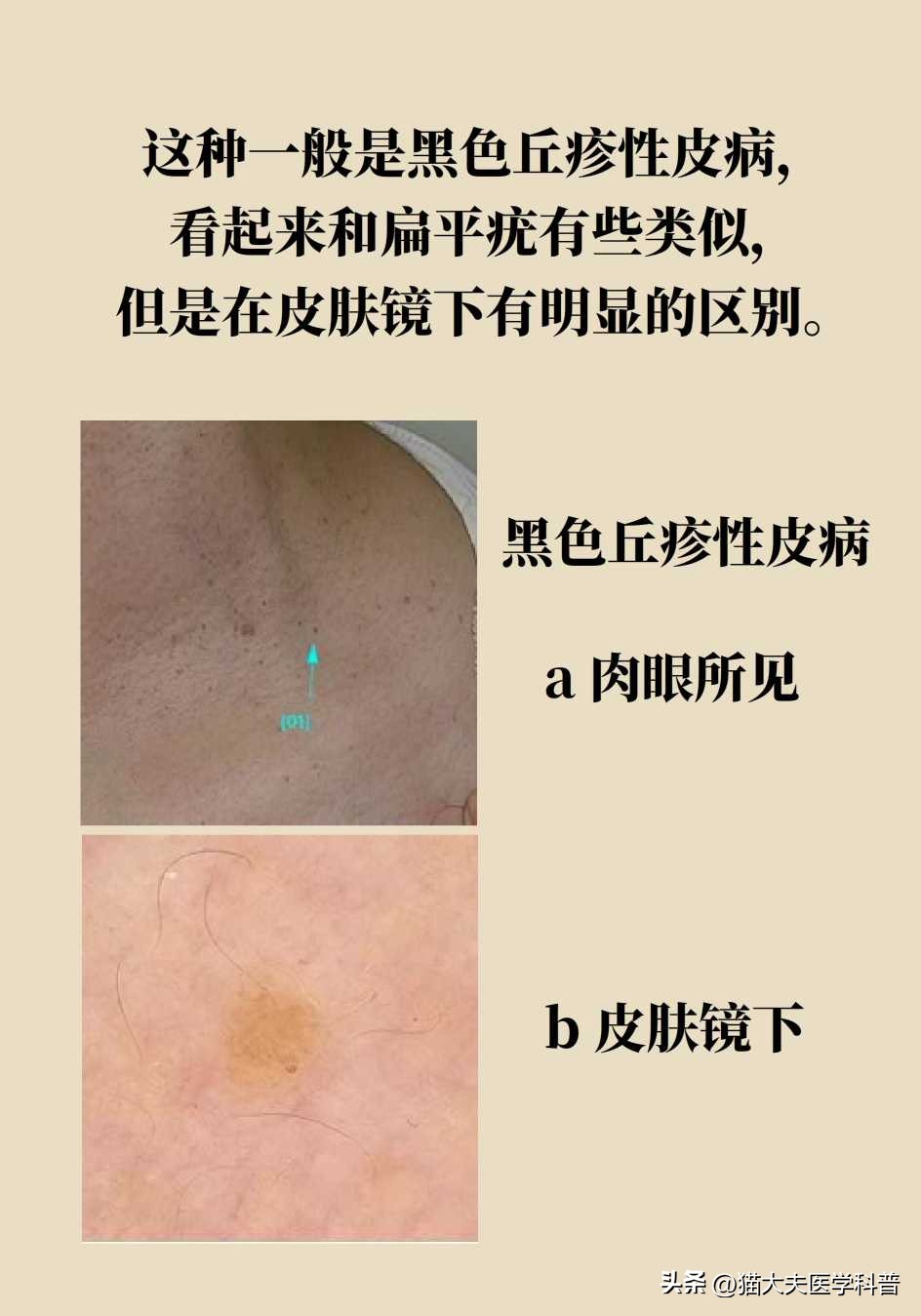 脖子上长的小肉揪怎么治啊,疣丝是不是脖子上的小肉粒