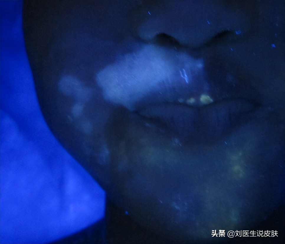 白癜风如何彻底治愈,白癜风怎么治疗才能彻底治愈