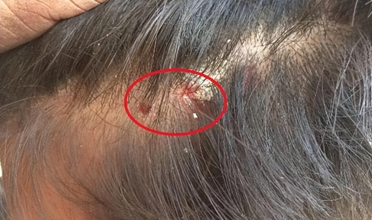 男士头上长疙瘩脓包,头上起疙瘩有脓包还掉发什么原因
