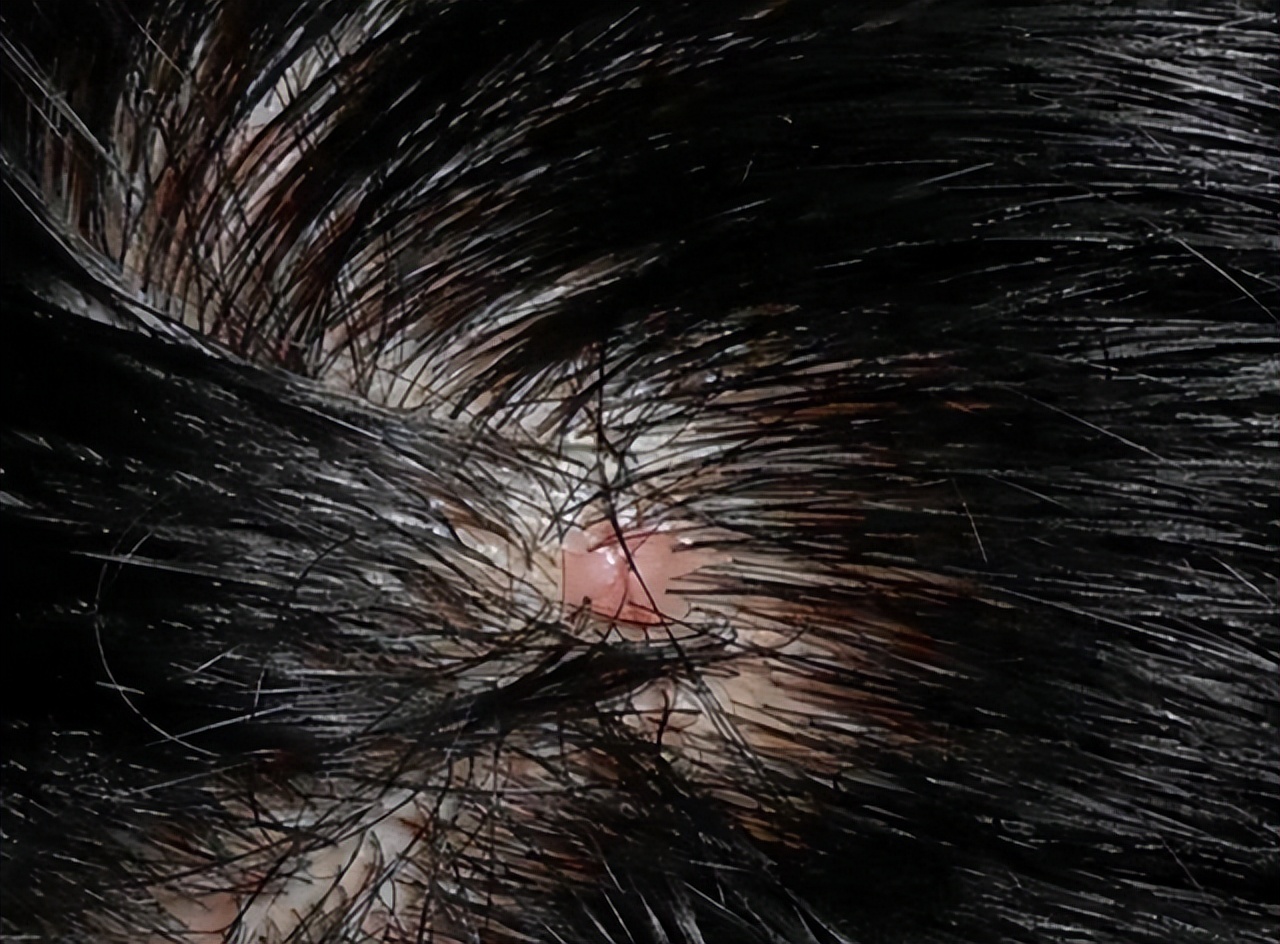 为啥头皮总长“脓包”和“疙瘩”？提示：或与这4点有关