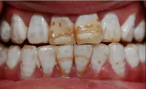 氟斑牙治疗的3种方法,氟斑牙怎么矫正