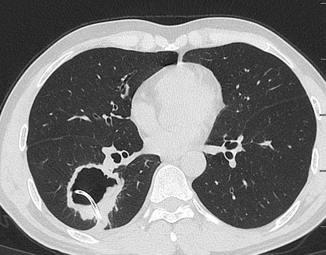 肺脓肿导管引流,肺脓肿的引流管脱落怎么办