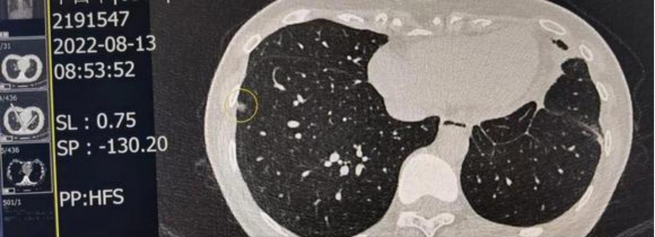 肺癌手术后什么时候能彻底恢复,肺癌手术后什么方法减轻病人痛苦