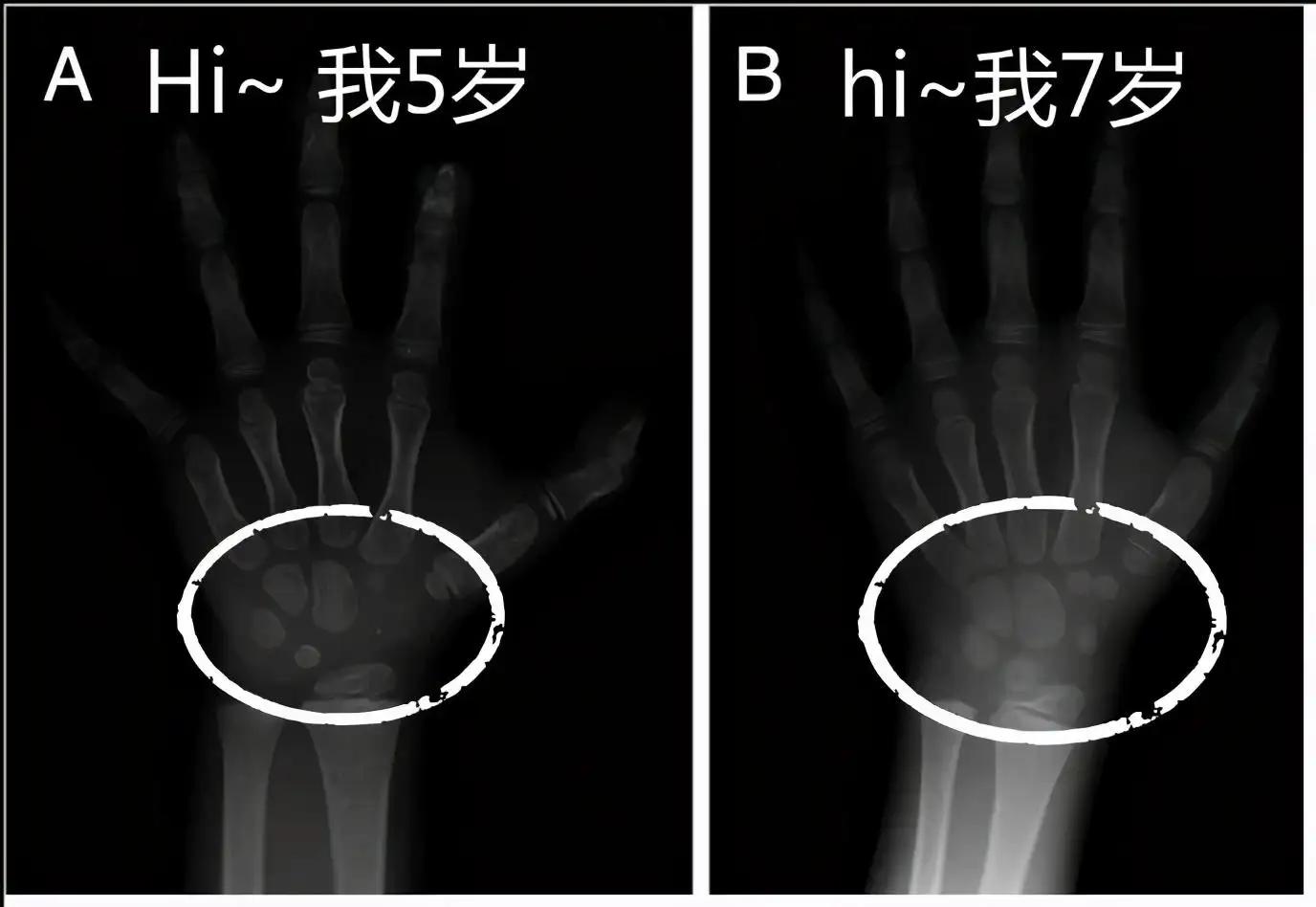 骨龄儿科医生,医生讲儿童骨龄片怎么看
