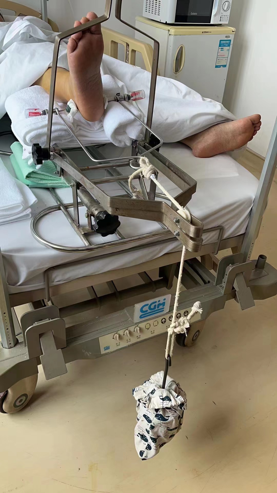 脚踝上侧骨折手术的全过程,脚踝骨折手术费用多少