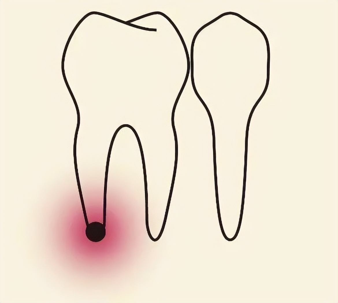 蛀牙到什么程度必须拔掉,蛀牙碰到神经了一定要做根管吗
