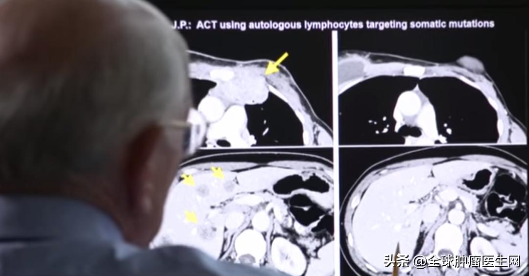 晚期乳腺癌成功抗癌的案例,乳腺癌免疫治疗晚期癌症的治愈率