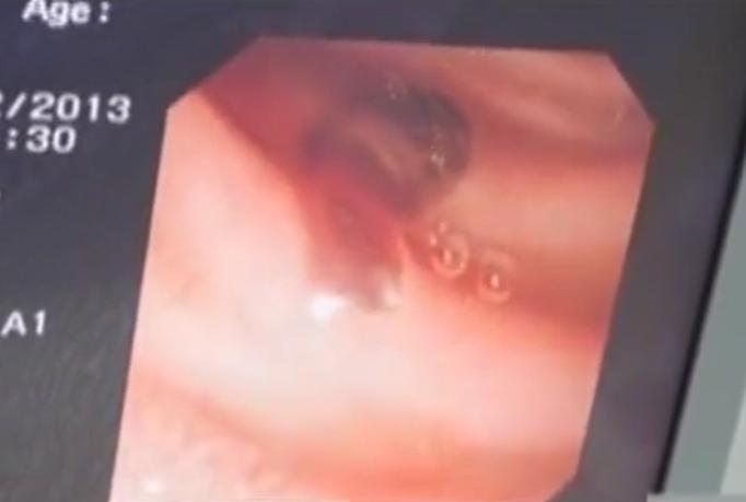 故事：湖北55岁男子病从口入，孕出成千上万虫卵，肚子竟成虫窝